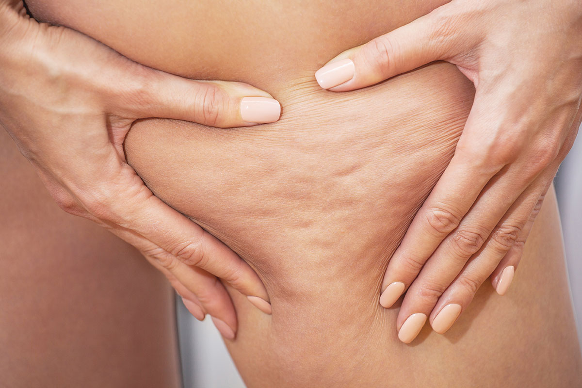 Hände greifen in den Oberschenkel – Lipödem oder Cellulite