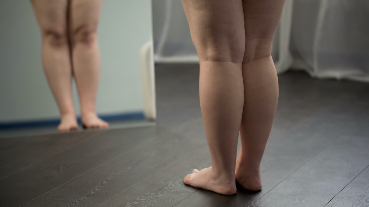 Gambe di un bambino con sintomi di lipedema